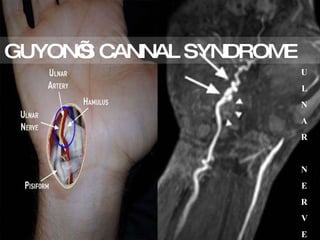 GUYON’S CANNAL SYNDROME   U L N A R N E R V E 