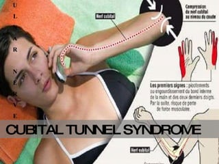CUBITAL TUNNEL SYNDROME   U L N A R N E R V E 