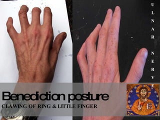 Benediction posture CLAWING OF RING & LITTLE FINGER U L N A R N E R V E 