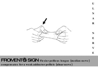 FROMENT’S SIGN   Flexior pollicus longus (median nerve) compensates for a weak adductor pollicis (ulnar nerve)   U L N A R N E R V E 
