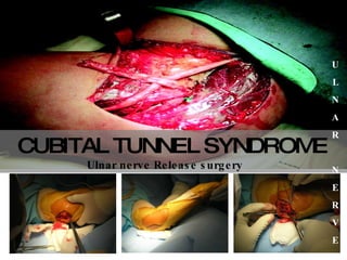 CUBITAL TUNNEL SYNDROME   Ulnar nerve Release surgery   U L N A R N E R V E 