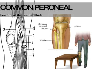 COMMON PERONEAL Fracture of the head of fibula 