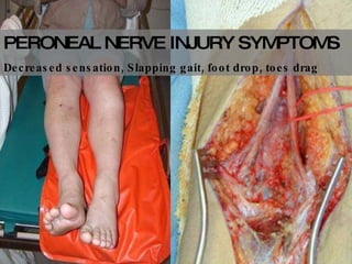 PERONEAL NERVE INJURY SYMPTOMS Decreased sensation, Slapping gait, foot drop, toes drag  