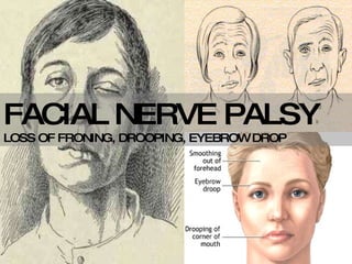 FACIAL NERVE PALSY  LOSS OF FRONING, DROOPING, EYEBROW DROP 