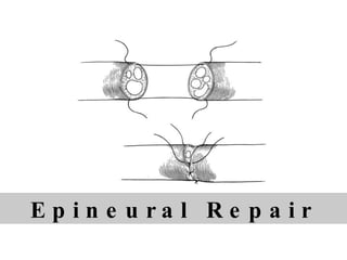 E p i n e u r a l  R e p a i r  