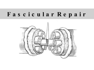 F a s c i c u l a r  R e p a i r  
