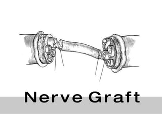 N e r v e  G r a f t 