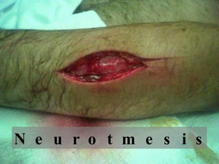 N  e  u  r  o  t  m  e  s  i  s 