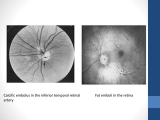 Calcific embolus in the inferior temporal retinal
artery
Fat emboli in the retina
 
