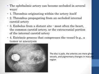 • The ophthalmic artery can become occluded in several
ways:
• 1. Thrombus originating within the artery itself
• 2. Thrombus propagating from an occluded internal
carotid artery
• 3. Embolus from a distant site - most often the heart,
the common carotid artery, or the extracranial portion
of the internal carotid artery
• 4. Extrinsic process that compresses the vessel (e.g., a
tumor or aneurysm
The disc is pale, the arteries are mere ghost
vessels, and pigmentary changes in macular
region
 