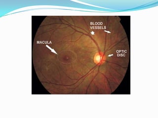 Normal fundus
 