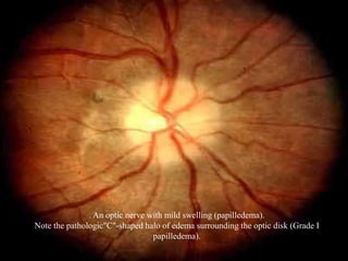 . An optic nerve with mild swelling (papilledema).
Note the pathologic"C"-shaped halo of edema surrounding the optic disk (Grade I
                                 papilledema).
 