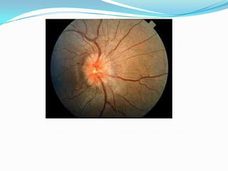 Grade II papilledema. The halo of edema now surrounds the optic disc
 