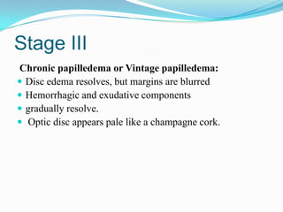 Stage III
Chronic papilledema or Vintage papilledema:
 Disc edema resolves, but margins are blurred
 Hemorrhagic and exudative components
 gradually resolve.
 Optic disc appears pale like a champagne cork.
 
