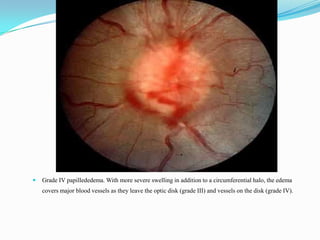    Grade IV papillededema. With more severe swelling in addition to a circumferential halo, the edema
    covers major blood vessels as they leave the optic disk (grade III) and vessels on the disk (grade IV).
 