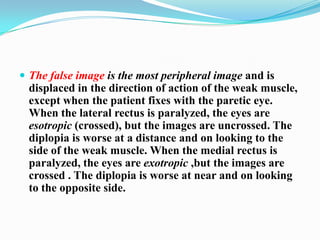  The false image is the most peripheral image and is
 displaced in the direction of action of the weak muscle,
 except when the patient fixes with the paretic eye.
 When the lateral rectus is paralyzed, the eyes are
 esotropic (crossed), but the images are uncrossed. The
 diplopia is worse at a distance and on looking to the
 side of the weak muscle. When the medial rectus is
 paralyzed, the eyes are exotropic ,but the images are
 crossed . The diplopia is worse at near and on looking
 to the opposite side.
 