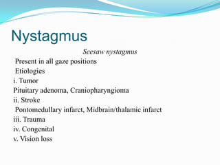 Nystagmus
                         Seesaw nystagmus
 Present in all gaze positions
 Etiologies
i. Tumor
Pituitary adenoma, Craniopharyngioma
ii. Stroke
 Pontomedullary infarct, Midbrain/thalamic infarct
iii. Trauma
iv. Congenital
v. Vision loss
 