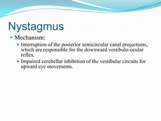 Nystagmus
 Mechanism:
   Interruption of the posterior semicircular canal projections,
    which are responsible for the downward vestibulo-ocular
    reflex.
   Impaired cerebellar inhibition of the vestibular circuits for
    upward eye movements.
 