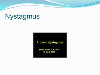 Nystagmus
 