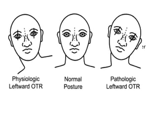 Intortion Neuro ophthalmology Basics | PPTX