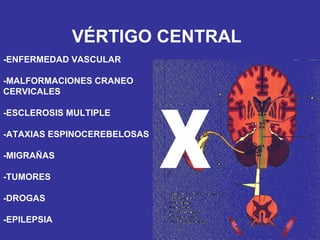 X VÉRTIGO CENTRAL -ENFERMEDAD VASCULAR -MALFORMACIONES CRANEO CERVICALES -ESCLEROSIS MULTIPLE -ATAXIAS ESPINOCEREBELOSAS -MIGRAÑAS -TUMORES -DROGAS -EPILEPSIA 