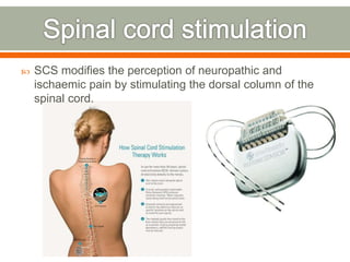  SCS modifies the perception of neuropathic and
ischaemic pain by stimulating the dorsal column of the
spinal cord.
 