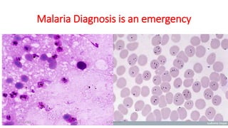 Malaria Diagnosis is an emergency
29-11-2023 Dr.T.V.Rao MD 22
 