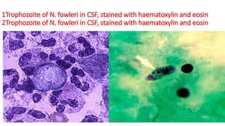 1Trophozoite of N. fowleri in CSF, stained with haematoxylin and eosin
2Trophozoite of N. fowleri in CSF, stained with haematoxylin and eosin
29-11-2023 Dr.T.V.Rao MD 43
 