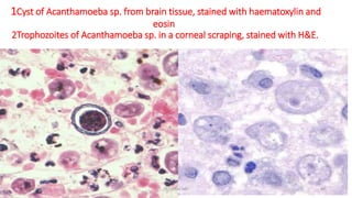 1Cyst of Acanthamoeba sp. from brain tissue, stained with haematoxylin and
eosin
2Trophozoites of Acanthamoeba sp. in a corneal scraping, stained with H&E.
29-11-2023 Dr.T.V.Rao MD 44
 