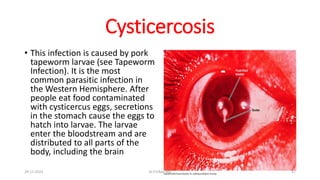 Cysticercosis
• This infection is caused by pork
tapeworm larvae (see Tapeworm
Infection). It is the most
common parasitic infection in
the Western Hemisphere. After
people eat food contaminated
with cysticercus eggs, secretions
in the stomach cause the eggs to
hatch into larvae. The larvae
enter the bloodstream and are
distributed to all parts of the
body, including the brain
29-11-2023 Dr.T.V.Rao MD 57
 