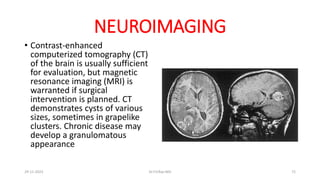 NEUROIMAGING
• Contrast-enhanced
computerized tomography (CT)
of the brain is usually sufficient
for evaluation, but magnetic
resonance imaging (MRI) is
warranted if surgical
intervention is planned. CT
demonstrates cysts of various
sizes, sometimes in grapelike
clusters. Chronic disease may
develop a granulomatous
appearance
29-11-2023 Dr.T.V.Rao MD 72
 