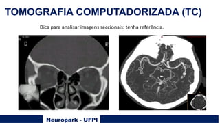 Neuropark - UFPI
TOMOGRAFIA COMPUTADORIZADA (TC)
Dica para analisar imagens seccionais: tenha referência.
 