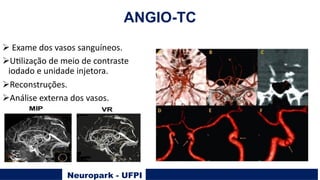 Neuropark - UFPI
ANGIO-TC
Ø Exame dos vasos sanguíneos.
ØUQlização de meio de contraste
iodado e unidade injetora.
ØReconstruções.
ØAnálise externa dos vasos.
 