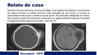 Relato de caso
Paciente do sexo feminino, 14 anos de idade, com quadro de cefaleia e crescimento
de massa tumoral na calota craniana com evolução de seis meses. A massa se
apresentava endurecida e media cerca de 10 cm. Foi realizada radiografia de crânio,
que mostrou lesão discretamente esclerótica na região parietal esquerda associada
a reação periosteal agressiva do tipo "raios de sol”.
Neuropark - UFPI
 