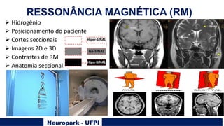 Neuropark - UFPI
Ø Hidrogênio
Ø Posicionamento do paciente
Ø Cortes seccionais
Ø Imagens 2D e 3D
Ø Contrastes de RM
Ø Anatomia seccional
Hiper-SINAL
Iso-SINAL
Hipo-SINAL
RESSONÂNCIA MAGNÉTICA (RM)
 