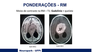 Neuropark - UFPI
PONDERAÇÕES - RM
Meios de contraste na RM – T1: Gadolínio + quelato
Sem M.C Com M.C
 