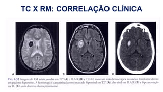 TC X RM: CORRELAÇÃO CLÍNICA
H
 