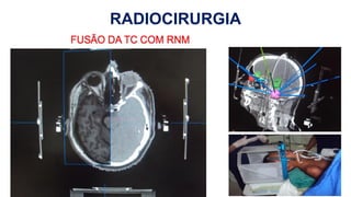 RADIOCIRURGIA
H
 