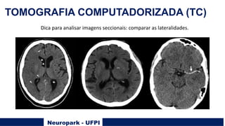 Neuropark - UFPI
TOMOGRAFIA COMPUTADORIZADA (TC)
Dica para analisar imagens seccionais: comparar as lateralidades.
 