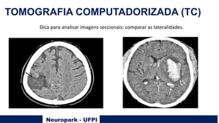 Neuropark - UFPI
TOMOGRAFIA COMPUTADORIZADA (TC)
Dica para analisar imagens seccionais: comparar as lateralidades.
 