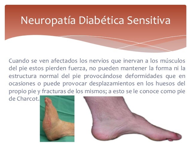 Neuropatía diabética Neuropatía diabética