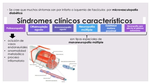 Neuropatía diabética Neuropatía diabética