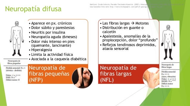 Neuropatía diabética Neuropatía diabética