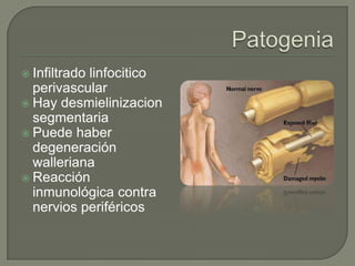  Infiltrado
           linfocitico
  perivascular
 Hay desmielinizacion
  segmentaria
 Puede haber
  degeneración
  walleriana
 Reacción
  inmunológica contra
  nervios periféricos
 