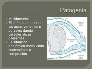  Multifactorial
 El daño puede ser de
  las astas ventrales o
  dorsales dando
  características
  diferentes
 La situación
  anatómica complicada
  susceptibles a
  compresión
 