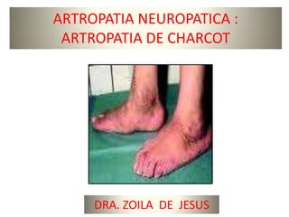 ARTROPATIA NEUROPATICA :
 ARTROPATIA DE CHARCOT




     DRA. ZOILA DE JESUS
 