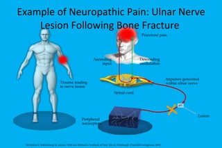 Example of Neuropathic Pain: Ulnar Nerve Lesion Following Bone Fracture  Ascending input Descending modulation Trauma leading to nerve lesion Perceived pain Impulses generated within ulnar nerve Spinal cord Peripheral  nociceptors McMahon S, Koltzenburg M, editors. Wall and Melzack's Textbook of Pain. 5th ed. Edinburgh: Churchill-Livingstone; 2005. Lesion 
