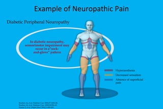 Example of Neuropathic Pain Diabetic Peripheral Neuropathy  In diabetic neuropathy, sensorimotor impairment may occur in a“sock- and-glove” pattern Hyperaesthesia Decreased sensation Absence of superficial pain Boulton AJ, et al. Diabetes Care 2004;27:1458–86.  Boulton AJ, et al.  Diabetes Care. 2005;28:956-62.  Kumar S, et al. Diabet Med 1994;11:480-484. 
