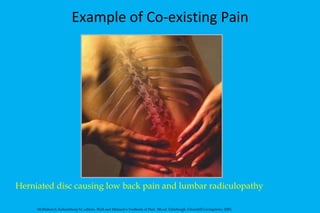 Example of Co-existing Pain Herniated disc causing low back pain and lumbar radiculopathy McMahon S, Koltzenburg M, editors. Wall and Melzack's Textbook of Pain. 5th ed. Edinburgh: Churchill-Livingstone; 2005. 