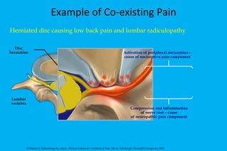 Example of Co-existing Pain Herniated disc causing low back pain and lumbar radiculopathy Lumbar vertebra McMahon S, Koltzenburg M, editors. Wall and Melzack's Textbook of Pain. 5th ed. Edinburgh: Churchill-Livingstone; 2005. Disc herniation Activation of peripheral nociceptors – cause of nociceptive pain component Compression and inflammation of nerve root – cause of neuropathic pain component 